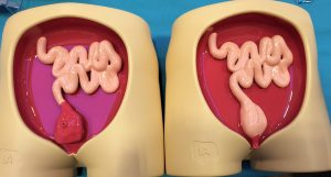 3D models show the surgical construction of a stoma (left) and internal pouch.